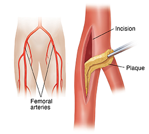 Femoral artery showing incision with instrument removing plaque. Locator shows position of femoral arteries.
