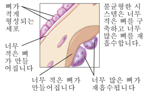너무 많은 뼈가 재흡수됩니다