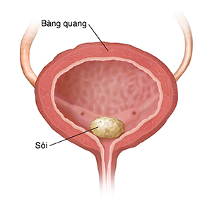 Mặt cắt ngang của bàng quang cho thấy sỏi bàng quang.
