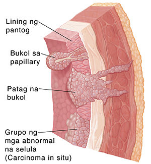 Cross section ng pinakadingding ng pantog na ipinakikita ang lining, submocosa, kalamnan, taba, at tatlong uri ng kanser: mga bukol na papilyari, mga bukol na nakadikit, at carcinoma in situ.