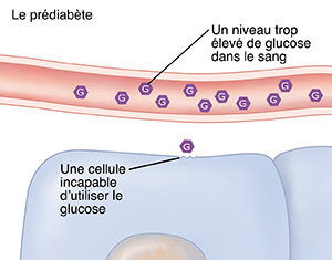 Coupe transversale d'un vaisseau sanguin et de cellules montrant un excès de glucose dans le sang en raison d'un prédiabète.